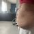 Enfin, je revis mieux après mon abdominoplastie
