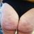 Cellfina pour enlever les trous sur les fesses