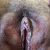 Nymphoplastie avec injection de graisse