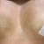 Lipofilling mammaire