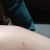 Cicatrices au niveau de la liposuccion