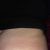 Opération abdominoplastie et liposuccion