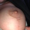 Mastopexie et lipofilling ou implants ? Mon expérience...