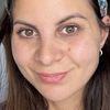 Hyaluronidase sous les pommettes (Juvederm)