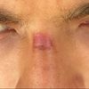 Laser : traitement d'une cicatrice au visage pour peau foncée