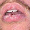 Lèvre du bas post point de suture