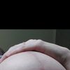 Aspect cicatrices 4 mois après une mastopexie