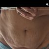Abdominoplastie : bas du ventre gonflé 7 mois après