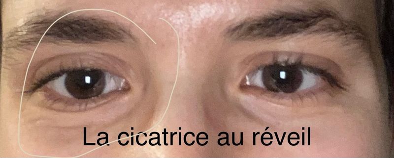 Cicatrice suite brûlure au retinol, Rosilea, oct. 2022