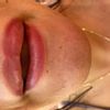 Irrégularités après AH lèvres