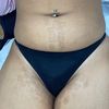 Brûlure après épilation laser 