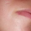 Cicatrice lèvre et front 