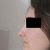 Profilage facial : rhinoplastie et genioplastie 