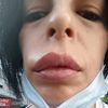 Retirer de l'acide hyaluronique injecté