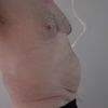Efficacité du traitement cryoliplise
