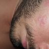Quel type de peeling ou autre technique pour corriger des marques d'acnés sur le visage ?