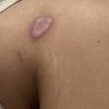 Cicatrice de liposuccion