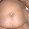 Demande de conseils pour une abdominoplastie