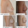 Mastopexie et AM ratée ? Besoin de conseils