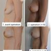 Mastopexie et AM ratée ? Besoin de conseils
