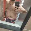 La partie supérieure du ventre gonflée après un bodylift