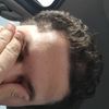 Je cherche une solution pour enlever une cicatrice au niveau du visage