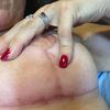 Photo apres 2 mois, seins et cuisses