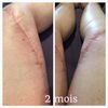 Photo apres 2 mois, seins et cuisses