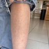 Kératose pilaire sur les jambes