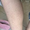 Kératose pilaire sur les jambes