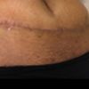 Soin cicatrice abdominoplastie J+27 