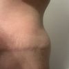 "Oreilles" après abdominoplastie