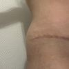 "Oreilles" après abdominoplastie