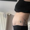 Abdominoplastie et diastasis