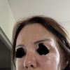 Full face raté? Botox fillers injection lèvres