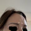 Full face raté? Botox fillers injection lèvres
