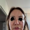 Full face raté? Botox fillers injection lèvres