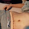 Abdominoplastie sans douleur 