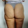 Aide: Petite liposuccion raté a tunis