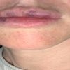Angoisse après  une injection d'acide hyaluronique dans les lèvres