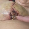 Infection et plaie beante apres mastectomie et reconstruction