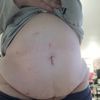 Abdominoplastie après Bypass