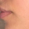 Lèvre blanche effet moustache après injections d'AH