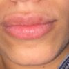Lèvre blanche effet moustache après injections d'AH