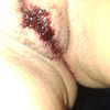 Nymphoplastie: saignement abondant à j+16