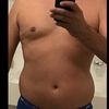 Homme Liposuccion ventre et hanche 
