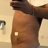 Homme Liposuccion ventre et hanche 
