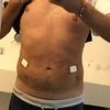 Homme Liposuccion ventre et hanche 