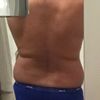 Homme Liposuccion ventre et hanche 