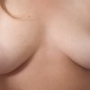Poitrine disgracieuse ou seins tubéreux ?